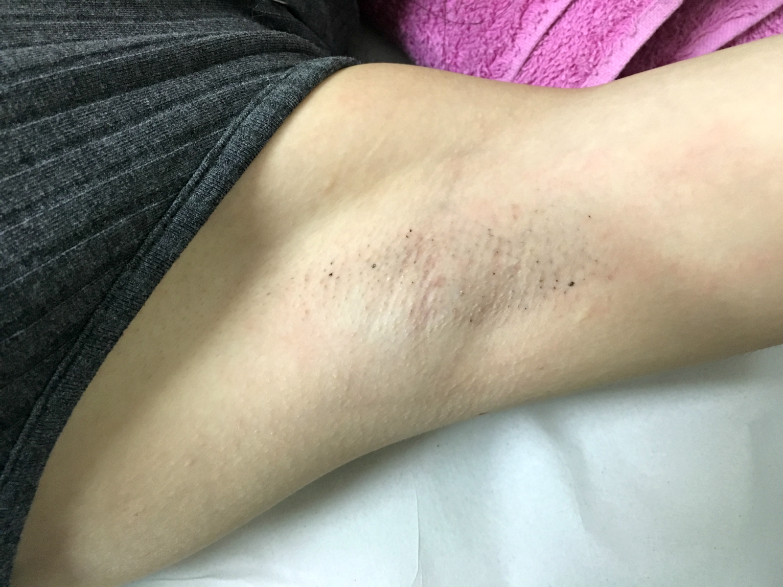 beleza | depilação a laser | depilação | depilação a laser preço | depilação a laser | depilação a laser meia perna | depilação a laser axila